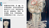 九旬退役老兵突发脑梗，医生妙术取出致命血栓