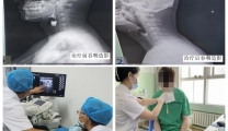 肉毒毒素注射治疗解决患者吞咽障碍