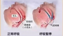 【健康科普】睡觉打鼾?警惕睡眠中的“杀手”