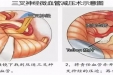 小骨窗破解“天下第一痛”