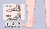 【健康科普】一种“脚踏实地”的痛——儿童扁平足