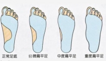 《襄阳晚报》孩子运动后足部酸胀      小心是后天性扁平足