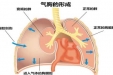 【健康科普】气胸可不是老年病