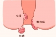 拒做有“痔”之士 内镜下轻松搞定