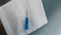 七岁女童误吞针头  内镜微创安全取出