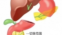 腹腔镜胰十二指肠切除术，成功分离隐藏肿瘤