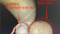 9小时战斗，驱逐心脏上的“不速之客”