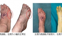 “裁缝趾”病例频发，骨科专家提醒注意足部健康与穿鞋习惯