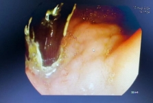 【湖北日报客户端】筷子十二指肠内“安家”四十载 医生联手内镜巧取出