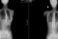 花季少女脊柱侧弯 矫正手术重拾笑容