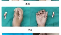 女宝右手长了2根拇指  医生巧妙矫形似无痕