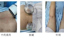 中医智慧显奇效 巧治腰突不手术