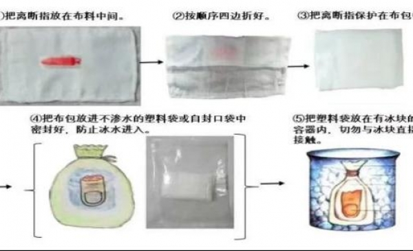 小伙三根手指完全离断  医生奋战8小时助其长回