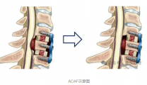 【汉水襄阳】颈椎治疗的“天花板”！市一医院骨科完成全市首例颈椎ACAF手术