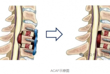【汉水襄阳】颈椎治疗的“天花板”！市一医院骨科完成全市首例颈椎ACAF手术